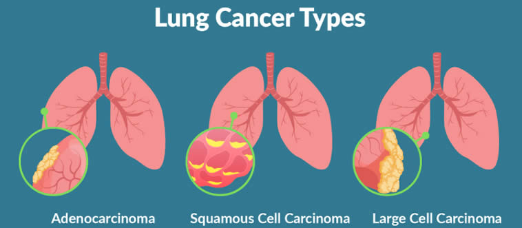 First instinct: which everyday habit is notoriously tied to a massive spike in lung cancer risk?